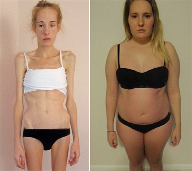 Mladá Australanka Gemma Walkerová porazila anorexii. Dívka v jeden okamik...