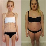 Mlad Australanka Gemma Walkerov porazila anorexii. Dvka v jeden okamik...