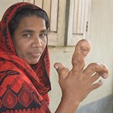 estaticetilet Afroza Begumrom z Banglade trp zhadnou nemoc, dky kter...