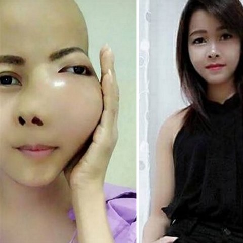 Sedmadvacetilet thajsk krska Jennie Yoo onemocnla agresivn formou rakoviny...