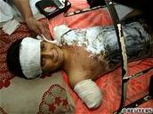 Zranný irácký chlapec