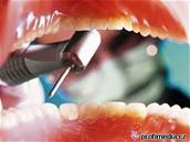 Parodontóza vzniká z tvorby plaku pi nedostateném itní zub.