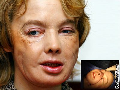 Vbec první transplantaci oblieje absolvovala v roce 2005 Francouzka Isabelle Dinoirová.