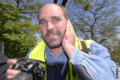 Fotoreportér Lubomír Kotek dostal na prvomájové demonstraci zásah policejní výbukou do oblieje.