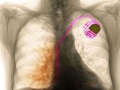 Kardiostimulátor v lidském tle pomáhá udret srdení rytmus