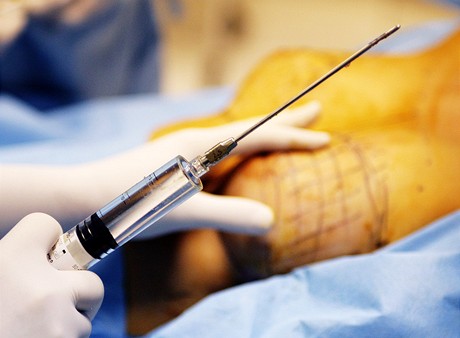 Operace prsou metodou Macrolane - zavdn kanyly