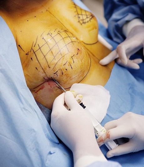 Operace prsou metodou Macrolane - aplikace gelu