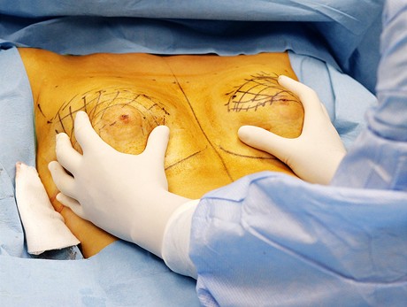 Operace prsou metodou Macrolane - kontrola symetrie 
