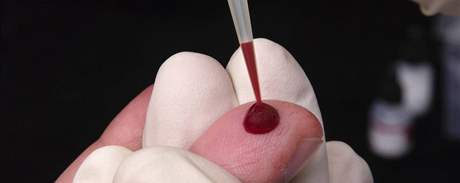 Odebírání krve pro test na HIV pozitivitu