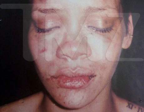 Zmlácená Rihanna - fotografii zveejnil portál TMZ.com (2009)