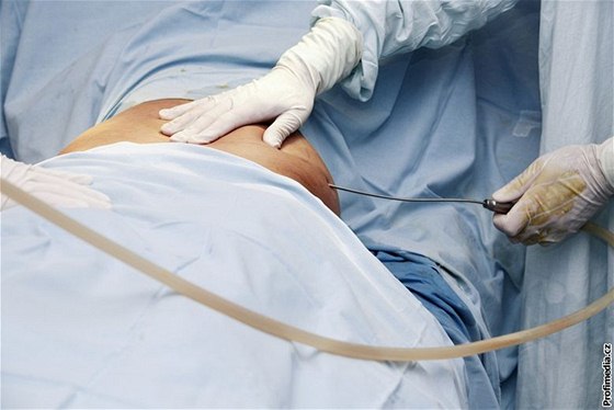 Pacientka aluje léebné centrum kvli operaci bicha. Místo napravení pevislého biního svalstva si ena odnesla velkou jizvu a trpla bolestmi. Ilustraní foto
