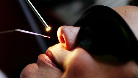 Chronická rýma - laserová mukotomie Chronická rýma - laserová mukotomie