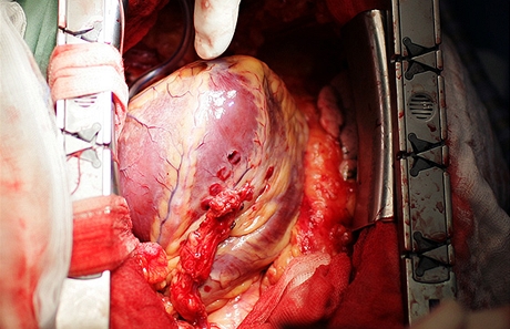 Operací srdce by mohlo v budoucnu díky novému léku ubýt. Ilustraní foto