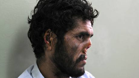 Lála Mohameda znetvoili Talibanci, te se léí v kábulské nemocnici (31. srpna 2009)