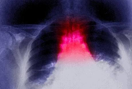 Zápal plic odhalí rentgenový snímek.