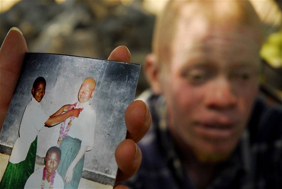 Nelehký údl albín v Tanzánii. Vumilia ukazuje fotografii svých spoluák, na ní je sedmnáctiletá albínka, kterou pedloni v kvtnu zabili dva mui, aby ásti jejího tla prodali amanovi.