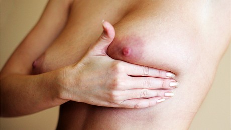 Samovyetení prsu by mla provádt ena kadý msíc (ilustraní snímek)