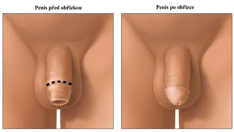 Obízka je nkdy jedinou moností, jak se zbavit problém s pedkokou