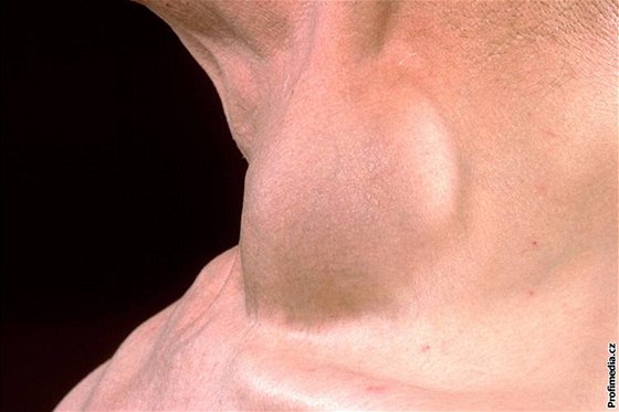 asem se nevzhledné uzliny objevily i na krku (ilustraní fotografie)
