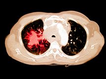 Rakovina plic u kuka - CT hrudnku, kter ukazuje rakovinu plic u 58letho...