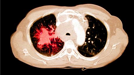 Rakovina plic u kuka - CT hrudnku, kter ukazuje rakovinu plic u 58letho kuka.