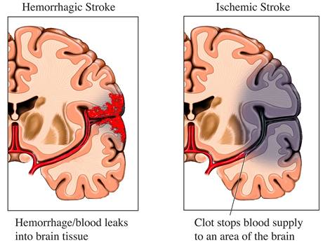 Hemoragick (vlevo) a ischemick (vpravo) mozkov phoda