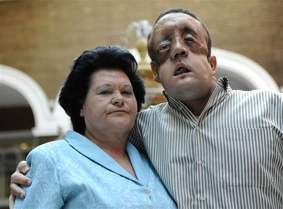 panl Rafael, kterému lékai transplantovali dv tetiny oblieje, se svou matkou.