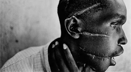 Zranní zpsobená maetou na tvái mue z kmene Hutu pi genocid v africké Rwand. (erven 1994)
