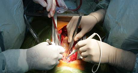 Unikátní operace srdení chlopn v nemocnici U svaté Anny v Brn.