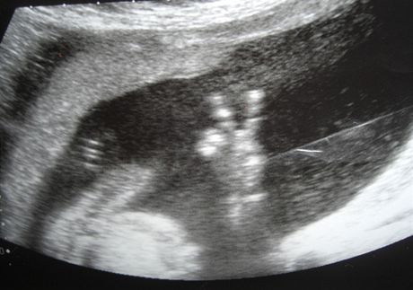 Vzkaz z ultrazvuku: miminko ukázalo "V" v dloze
