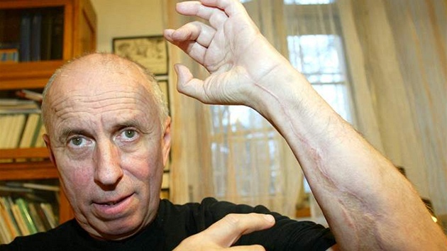 Karel Hynek ukazuje jizvy, které mu zůstaly po útoku mačetou Karel Hynek ukazuje jizvy, které mu zůstaly po útoku mačetou