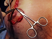Konen it po vloen implantt - plastick operace prsou tenky