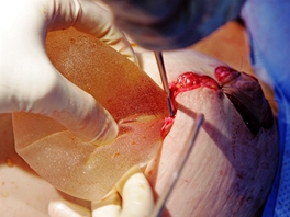 Vloen implanttu - plastick operace prsou tenky Jaroslavy 