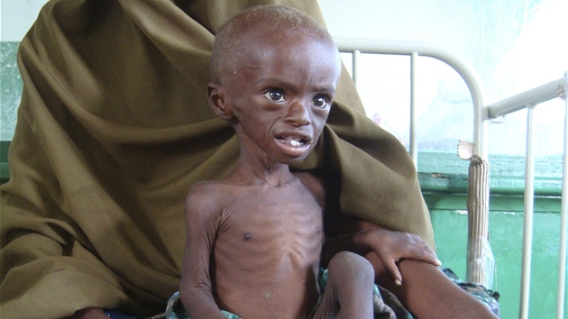 Siln podvyivený tíletý Abdihakin Omar v nemocnici Benadir v Mogadiu (21.