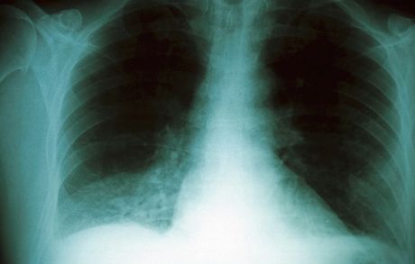 Ped tinácti lety lékai zjistili Michalovi plicní tuberkulózu a tuberkulózu lebení kosti (ilustraní snímek)