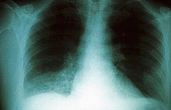 Ped tinácti lety lékai zjistili Michalovi plicní tuberkulózu a tuberkulózu lebení kosti (ilustraní snímek)