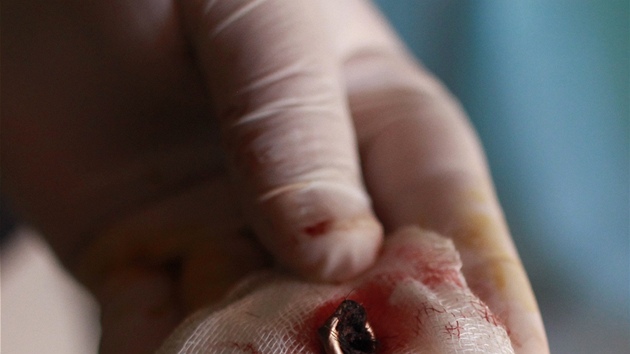 Kulku, kterou lékai v Závíji vytáhli z hlavy jedné zabité eny. Údajn jí