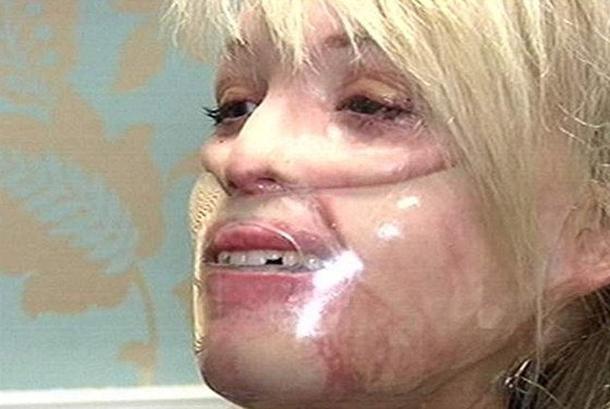 Katie Piperová musela po operacích 23 hodin denn nosit plastovou masku, která...