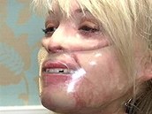 Katie Piperov musela po operacch 23 hodin denn nosit plastovou masku, kter...
