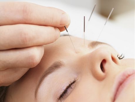 Akupunktura pomáhá i pi bolestech hlavy.
