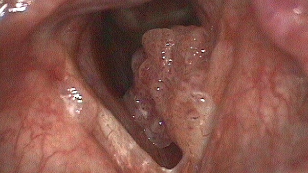 Papillomatosa hrtanu  kvtákovitý papillom, devastuje hlas a znesnaduje...