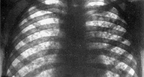 Loni se v Olomouckém kraji nakazily ti desítky lidí tuberkulózou. Jejich plíce pak mohou vypadat i takto (tmavé skvrny na rentgenovém snímku plic jsou píznakem akutní plicní tuberkulózy).