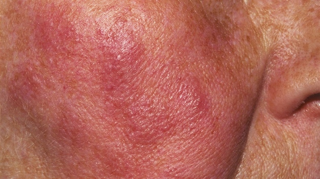 Lupus erythematosus (ilustrační snímek) Lupus erythematosus (ilustrační snímek)