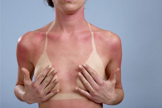 Nadmrné slunní a nedostatená ochrana proti UV záení vede k nepíjemným