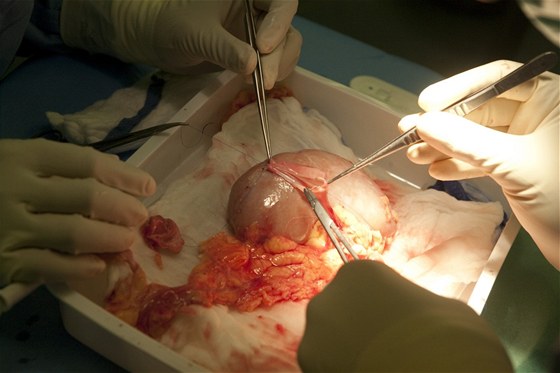 Píprava ledviny urené k transplantaci. Ilustraní snímek