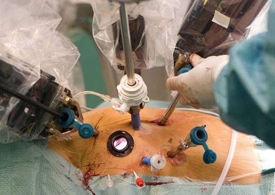 Operace srdce za pomoci robota - Jedno z ramen robota nese kameru, která v tle