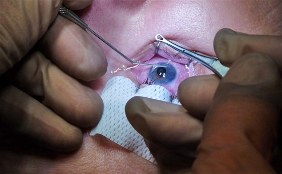 Kombinovaná operace spoívá v náhrad zkalené oky a implantaci umlé duhovky (ilustraní foto).