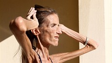 Valeria Levitinová je pravděpodobně nejhubenější ženou na světě. Valeria Levitinová je pravděpodobně nejhubenější ženou na světě.