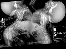 Rentgenový snímek siamských dvojat Allison a Amelie Tuckerových. Chirurgové v...