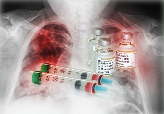 Pneumonii obvykle prokáe rentgen hrudníku a krevní testy (ilustraní snímek).